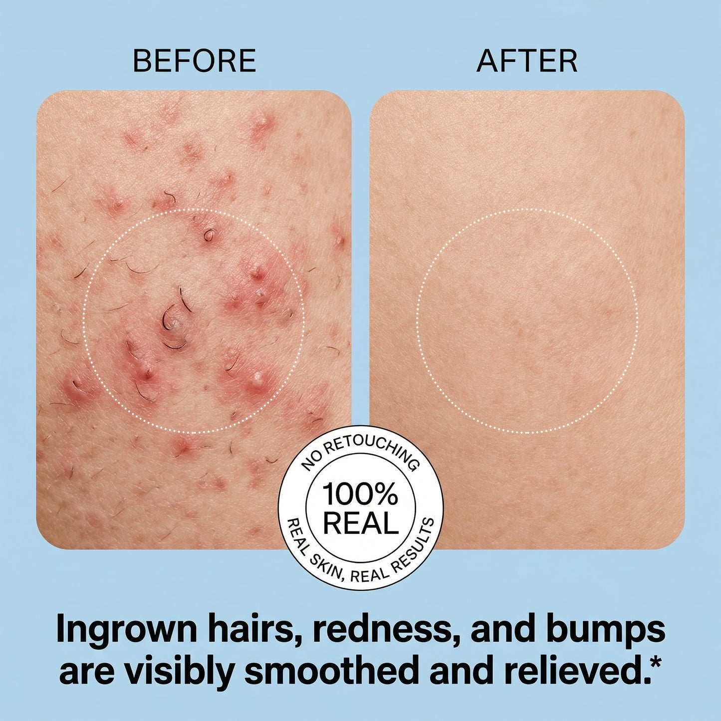PleasingStore Smoothing Solution Roll-On Treatment for Ingrown Hairs, Razor Bumps & Rough Post-Shave Skin